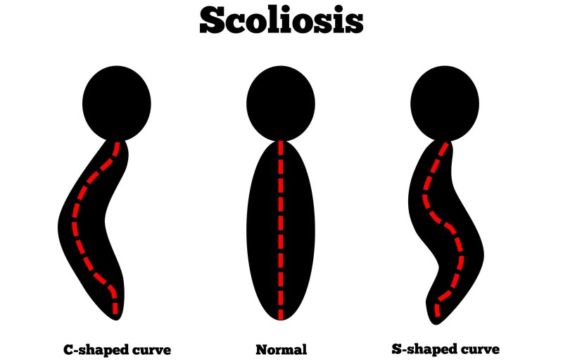 Frisco, TX scoliosis treatment